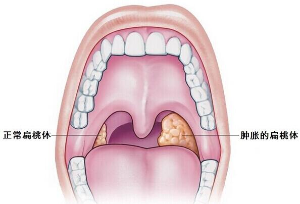 扁桃体化脓是怎么回事